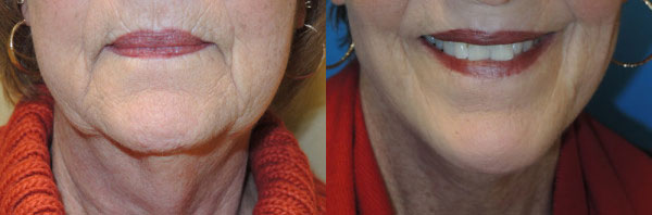 Before & After Facelift