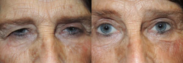 Functional Upper Eyelid Blepharoplasty - Before and After