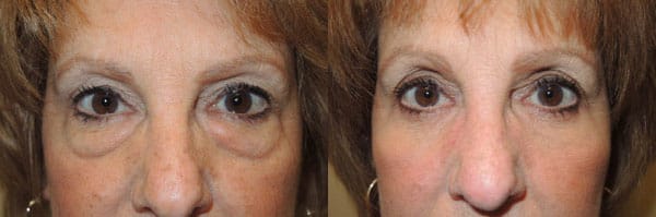 Before/After Lower Blepharoplasty