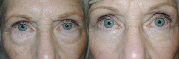 Before/After Lower Blepharoplasty